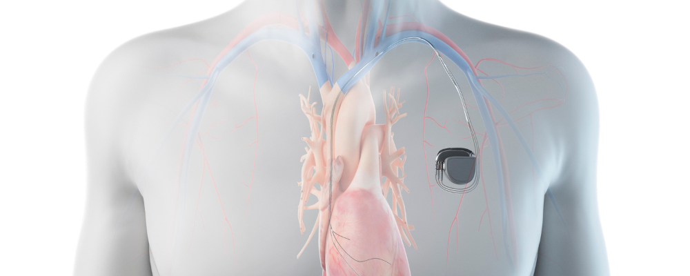 Image of a fitted pacemaker
